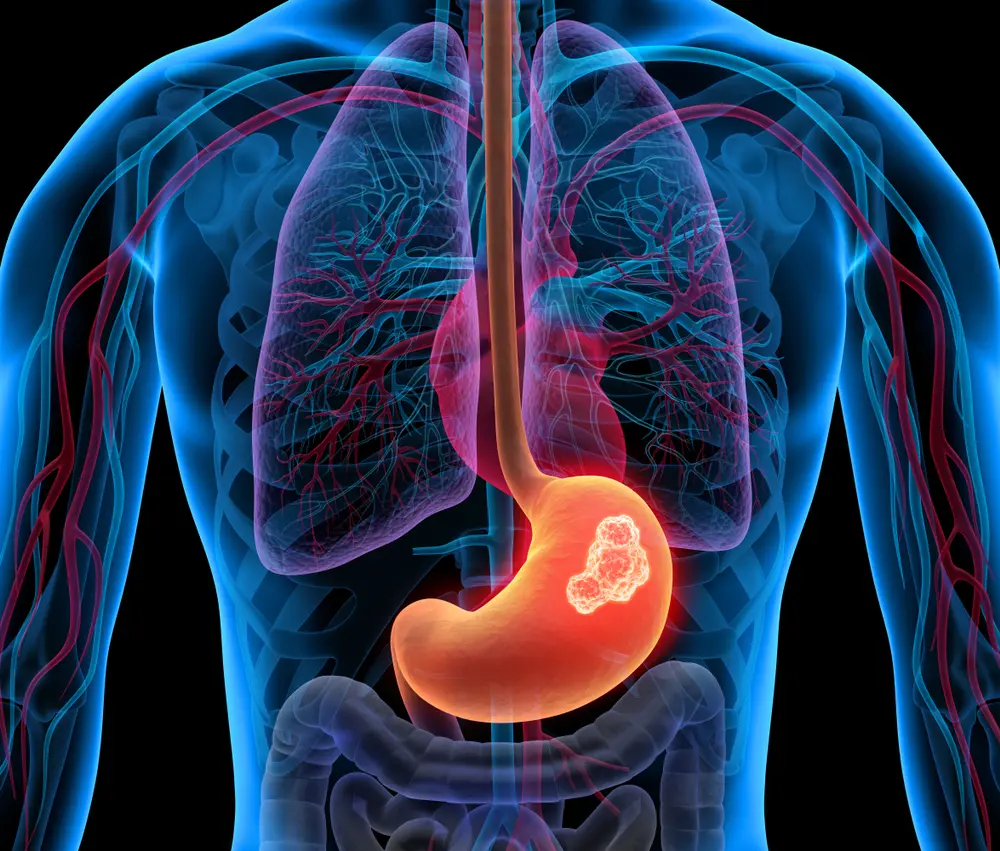 A patient with multiple health issues-anaemia, congestive heart failure, bronchial asthma, vomiting- gets diagnosed with Gastrointestinal Stromal Tumor (GIST). High risk surgery successfully performed by Dr. Avinash Tank